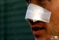 مردی که بینی خود را عمل زیبایی کرد| جزئیات ماجرا
