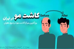 بهترین کلینیک کاشت مو و ابرو در تهران
