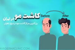 بهترین کلینیک کاشت مو و ابرو در تهران
